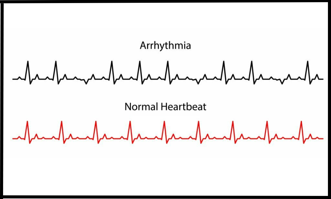 Arrhythmia and Palpitation Evaluation