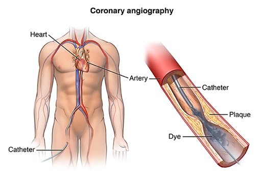 Cardiac Catheterization