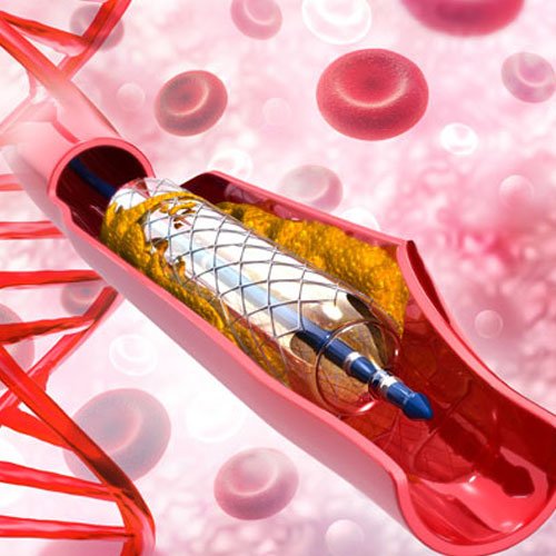 Complex Coronary Angioplasty