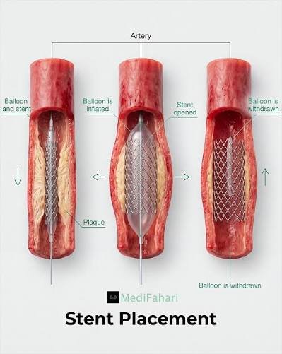 Coronary Stent Placement