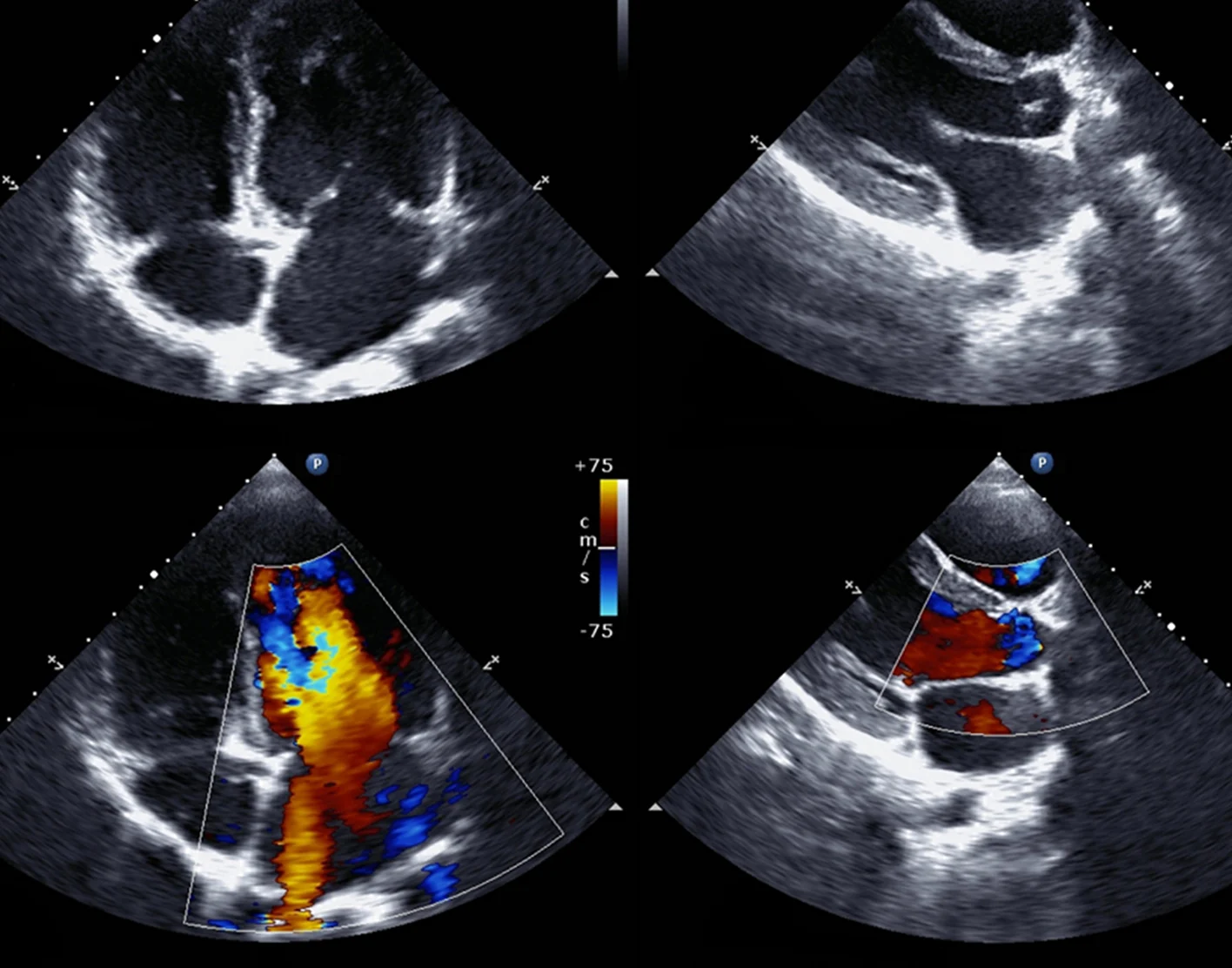 Echocardiography